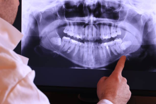 Best Emergency Tooth Extraction in New City, NY